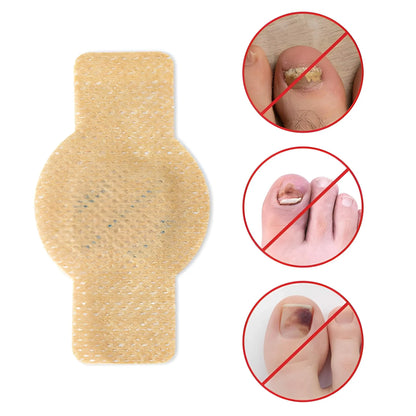 NailHeal™ - Fungal Nail Patches | Pack Of 10 | BUY 1 GET 1 FREE